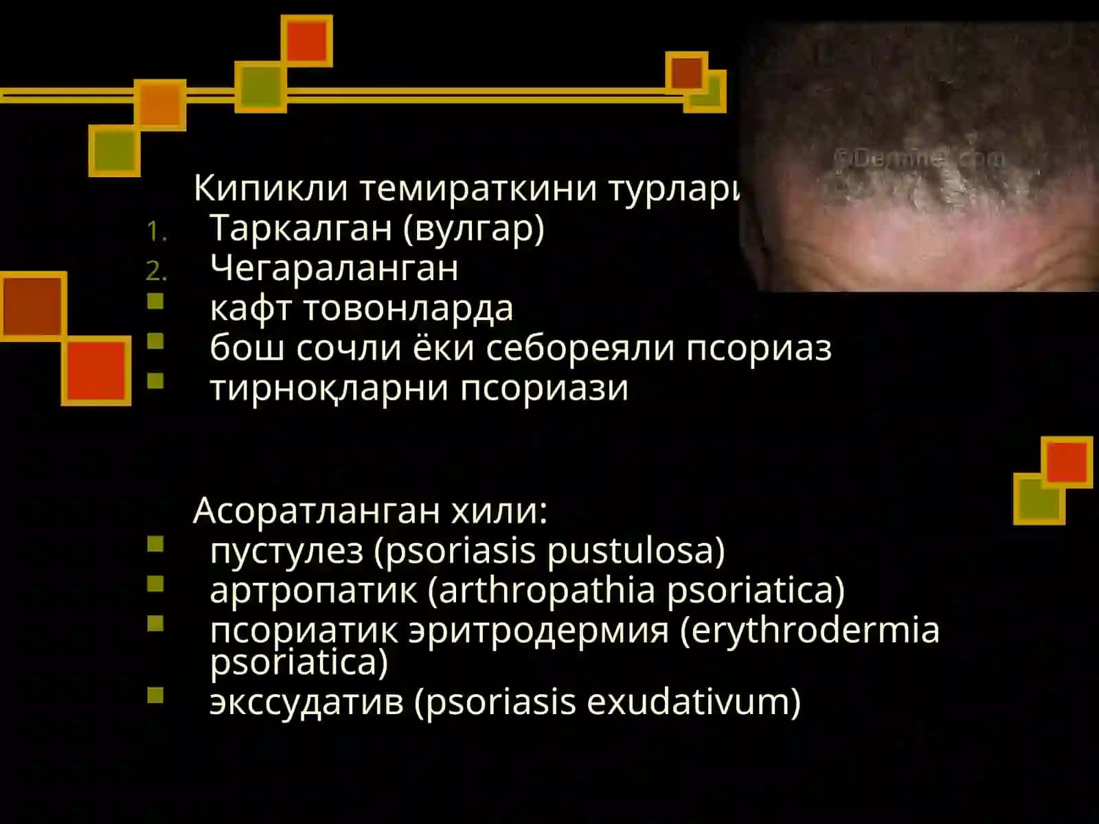 Псориаз, кизил ясси темиратки, Жибернинг пушти рангли темираткиси 4