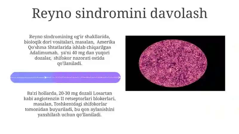 Tizimli Qizil Yugurukni Davolash 4
