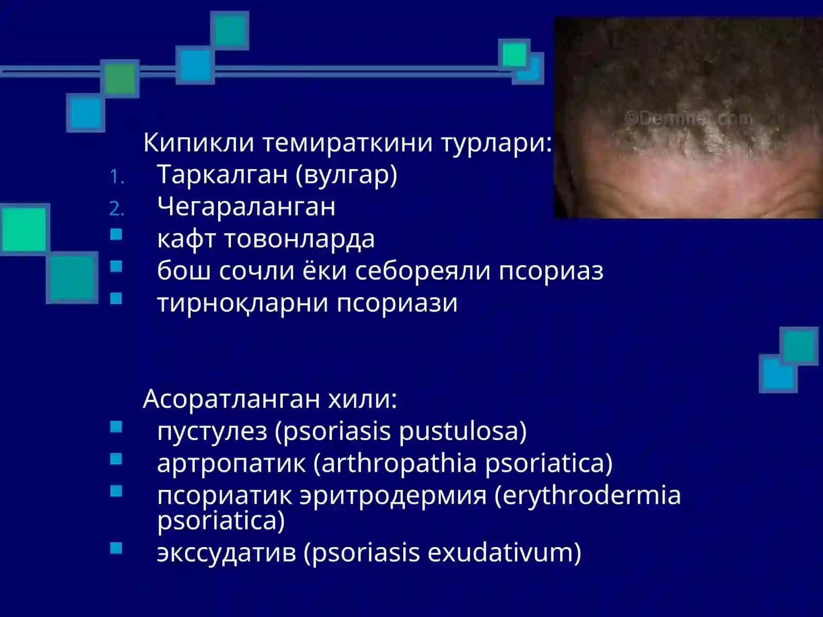 Псориаз, кизил ясси темиратки, Жибернинг пушти рангли темираткиси 4