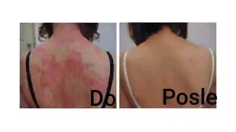 Parapsoriaz 4