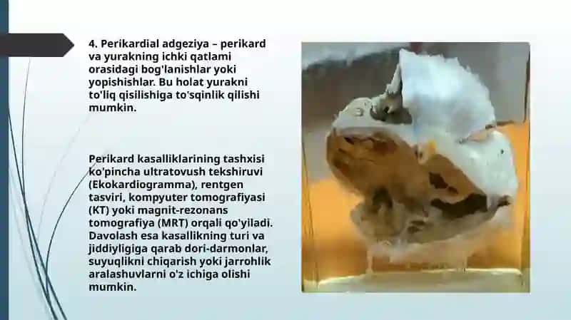 Perikard kasalliklari. Yurak o‘smalari 4