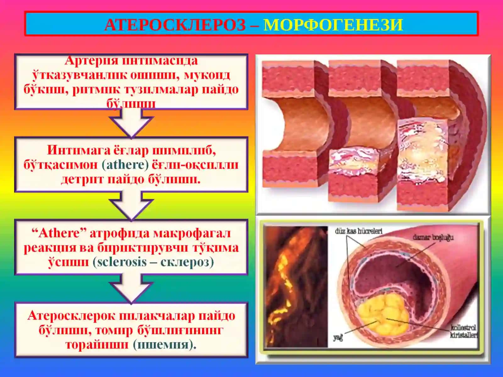 Атеросклероз. Гипертония касаллиги 4