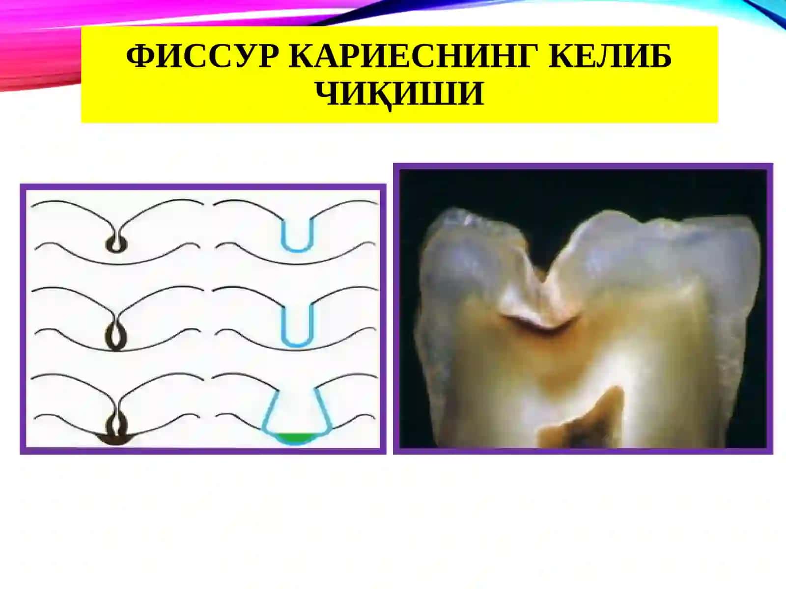 Хар ҳил босқичдаги кариес касалликларини клиникаси. Қиёсий ташҳиси. 4