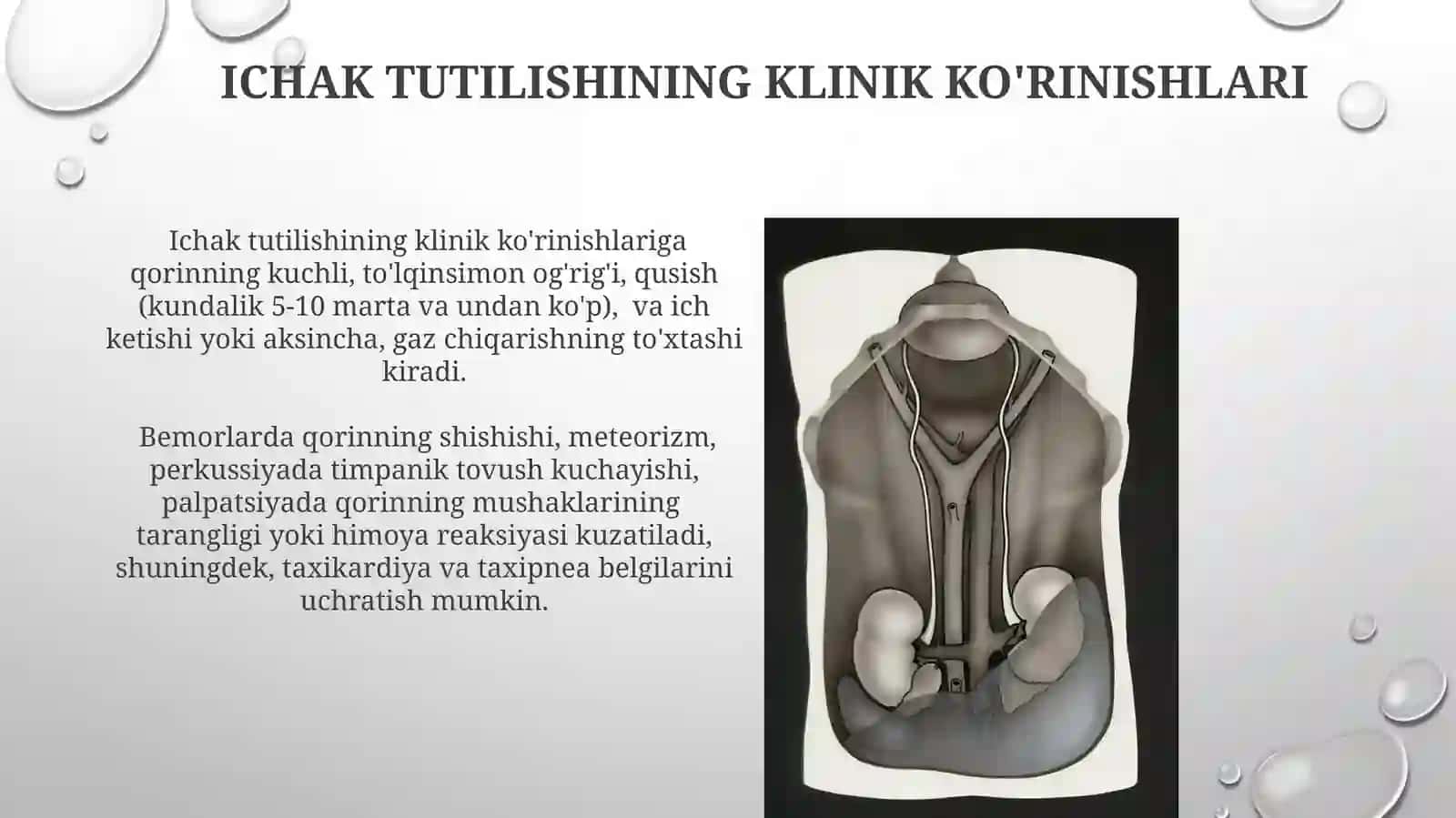 Òtkir ichak tutilishi va peritonitlar 4