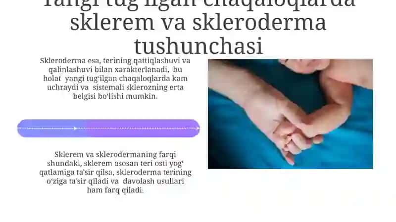 Yangi tug'ulgan chaqaloqlarda sklerema va skleredema 4