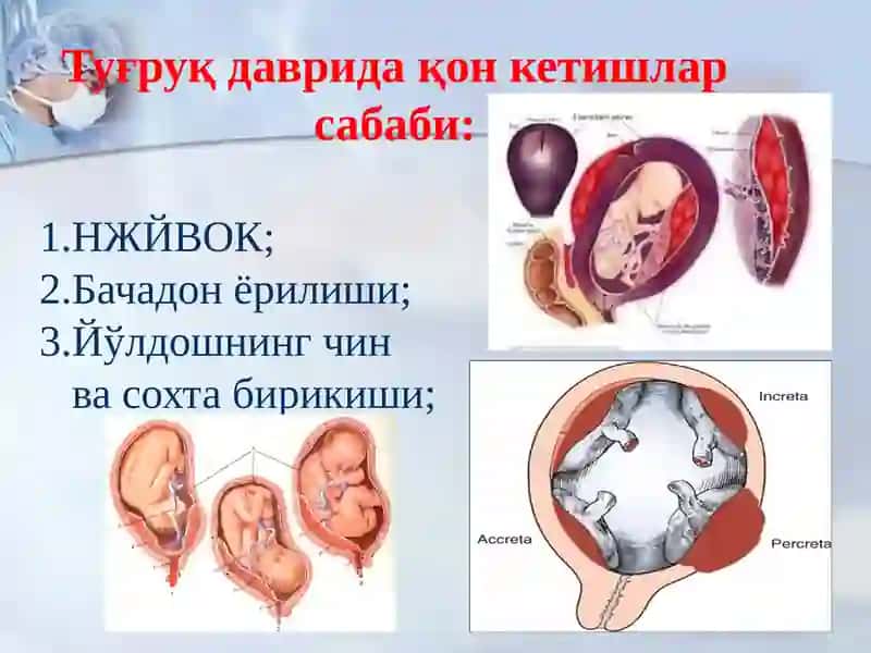 Хомиладорликнинг II – III триместрларида ҳамда туғруқдан кейинги қон кетишлар 4