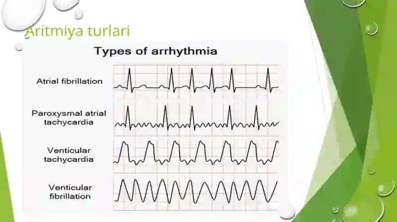Aritmiyalarda EKG interpretatsiyasi 4