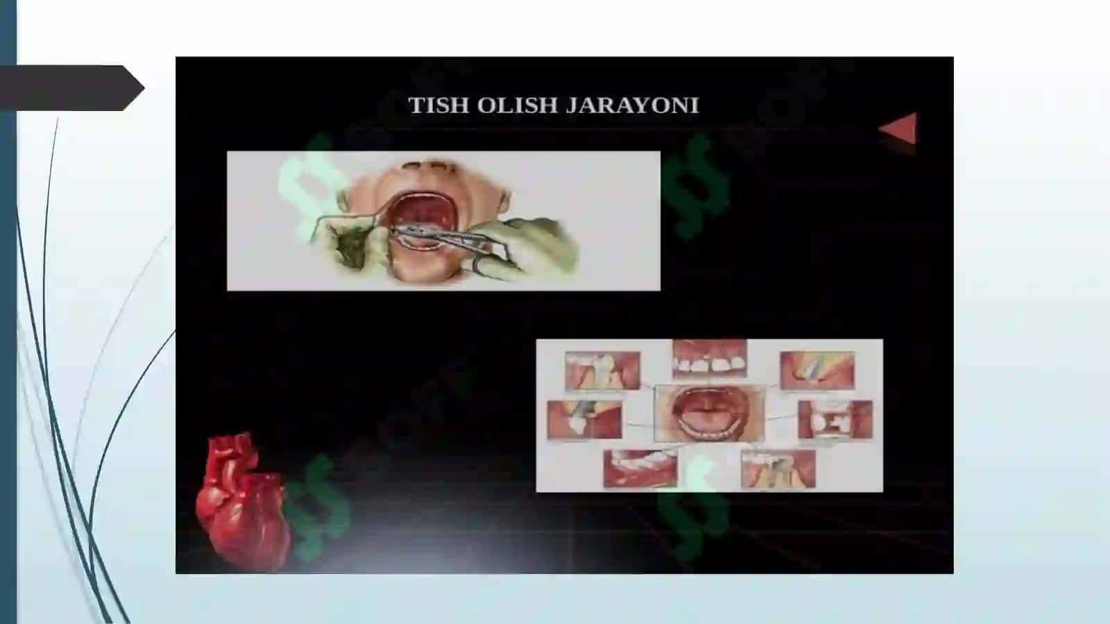 Tish olish operatsiyalari. Kursatmаvаqаrshi kursаtmа. Аsоrаtlаr. Pеriоstit,аbsеss, flеgmоnа. Tаsnifi, klinikаsi, tаshхisi vаdаvоlаsh 4