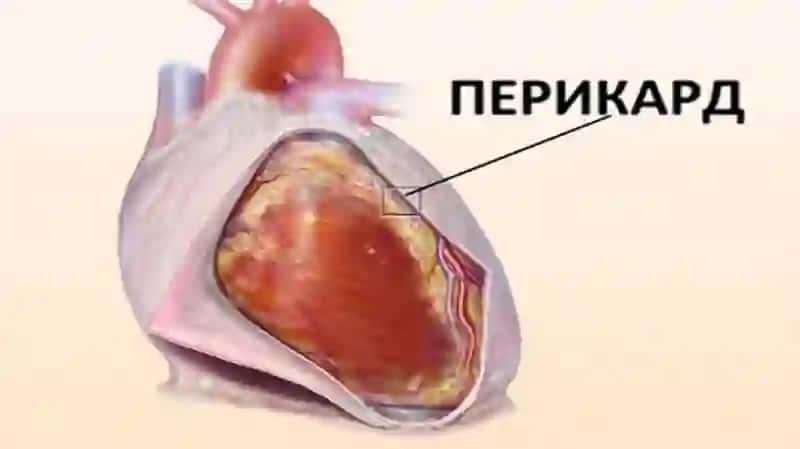 PERIKARD KASALLIKLARI. YURAK OS’MALARI.YURAK TRANSPLANTATSIYASI 4