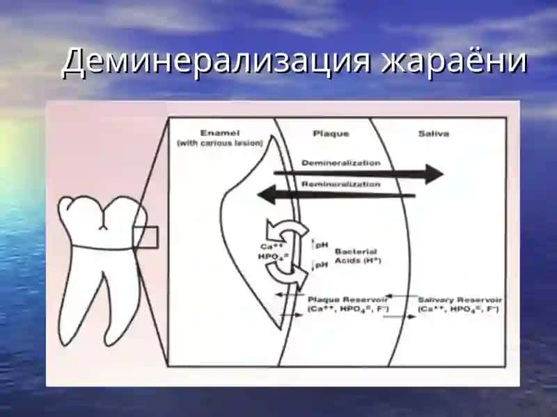 Кариесҳақида тушунча. Кариес ковакларни таснифи 4