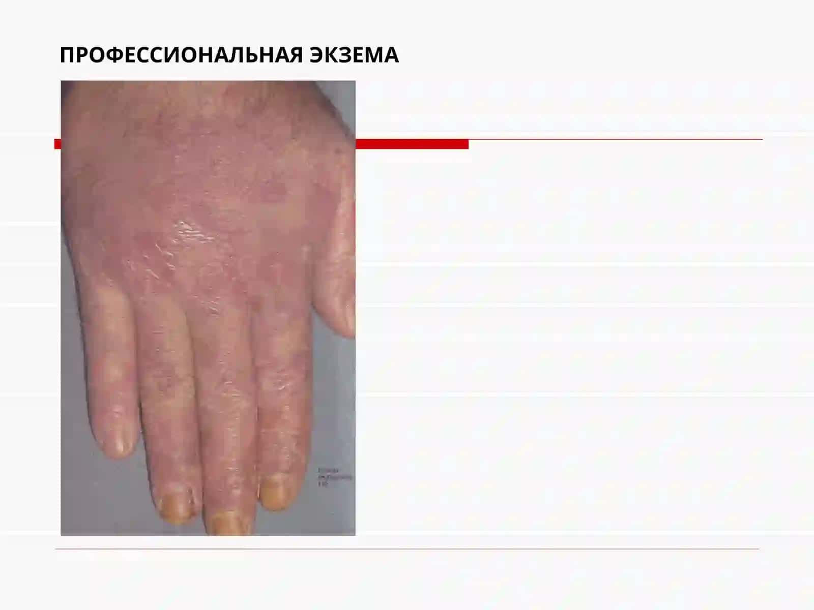 Аллерго ванейродерматозлар 4