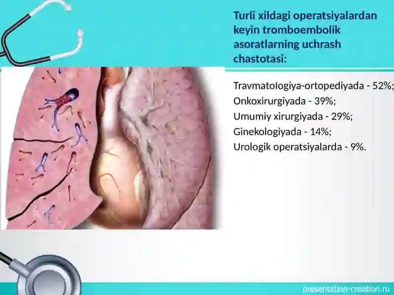 O'pka arteriyasi tromboemboliyasi (O'ATE) 4