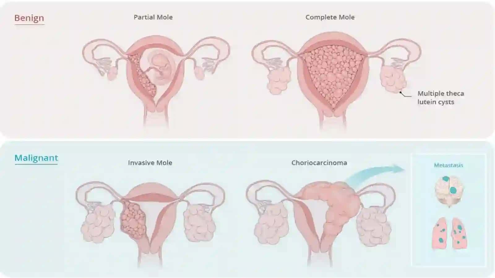 Elbug‘oz (pufaksimonsirpanma). Xorionkarsinoma. Diagnostika, davolash va olishtaktikasi 4