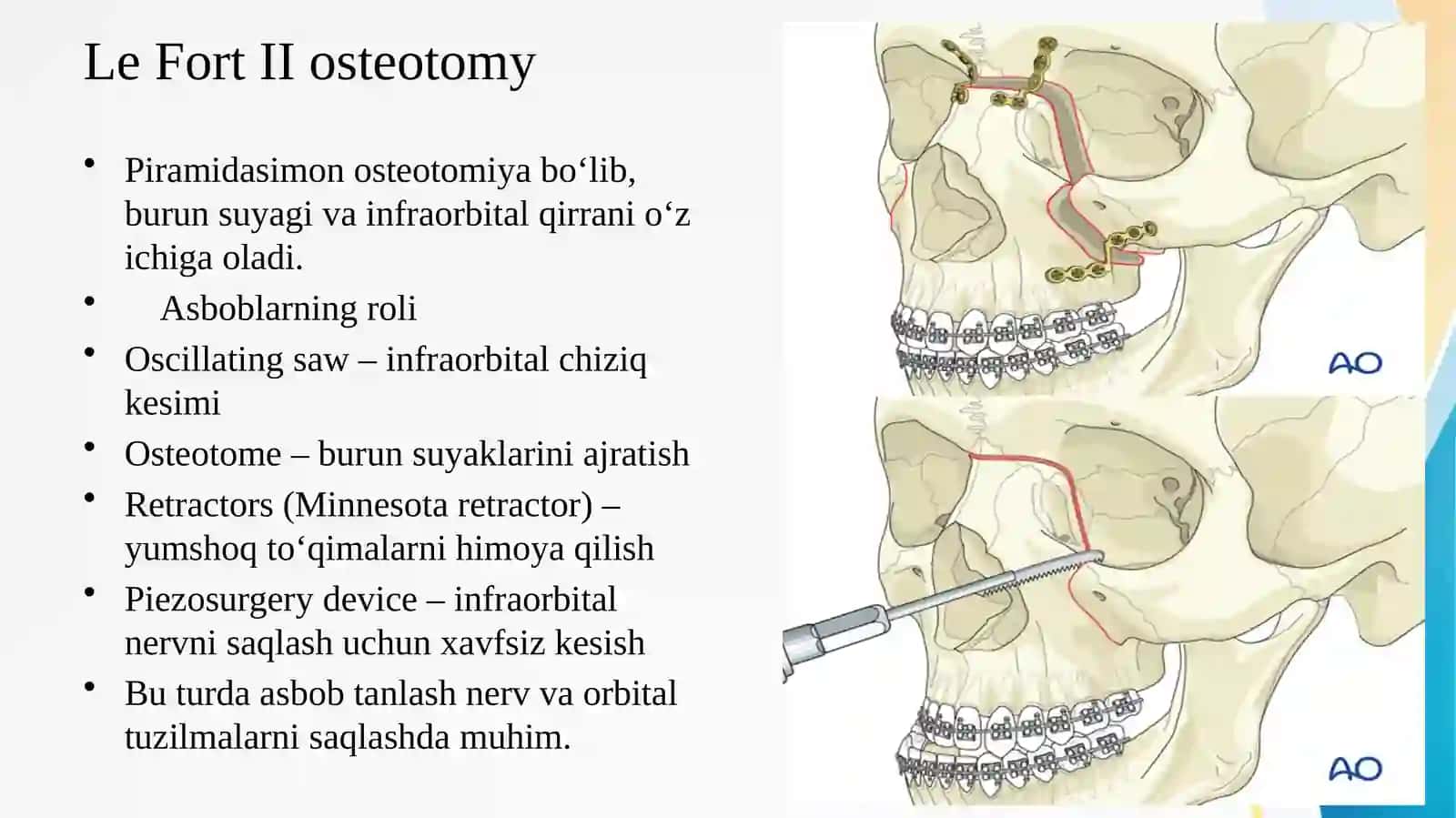 Osteotomiyada ishlatiladigan asbob-anjomlar   Остеотомияда ишлатиладиган инструментлар  LEFOR 1,2,3 tip boyicha,pastki jagda segmentli osteotomiya, BRIDE usuli bo’yicha osteotomiya 4