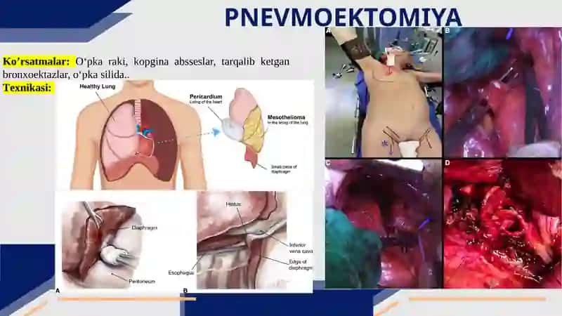 O‘pkalar va plevraning topografiyasi. Plevra bo’shlig’i, plevra sinuslari. Diafragmaning topografiyasi. Pnevmatoraks turlari O‘PKA JAROXATLARIGA CHOK QUYISH. PNEVMOEKTOMIYA. LOBEKTOMIYA. 4