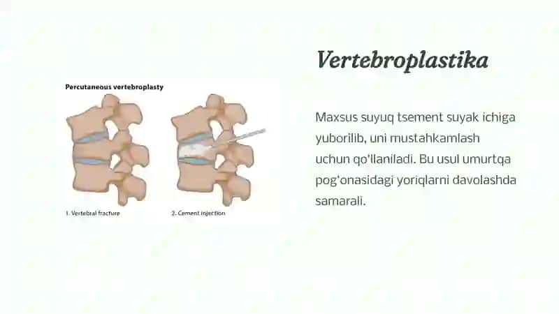 Umurtqapog'onasi va orqa miyashikastlanishinidavolash 4