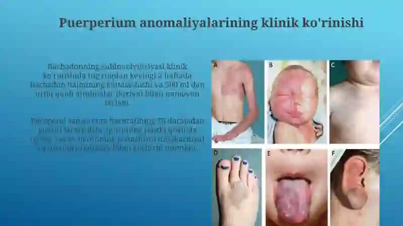 Puerperal davr anomaliyalari etialogiyasi klinikasi va diagnostikasi 4