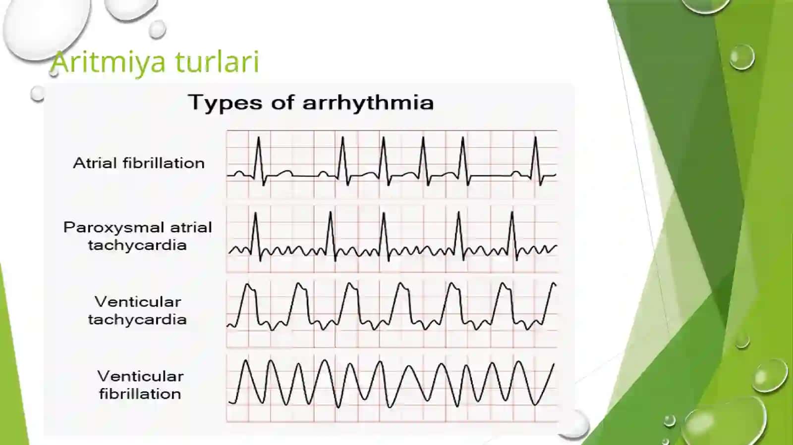 Yurak aritmiyalari EKG diagnostikasi 4