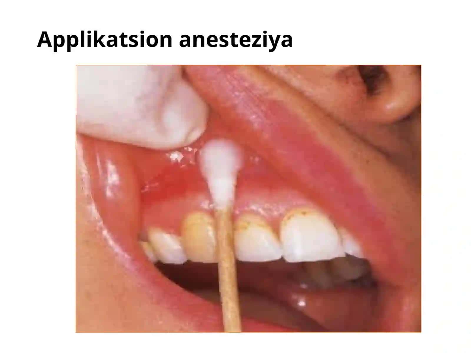 Terapevtik stomatologiya ichlatiladigan anesteziya turlari 4