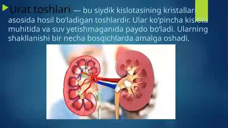 Buyraklarda urat toshlarini hosil bo‘lishi va davolash yo‘llari.Orotatsiduriya, uning sabablari va uridin bilan davolash mexanizmi 4