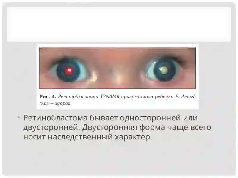 Ретинобластома 4