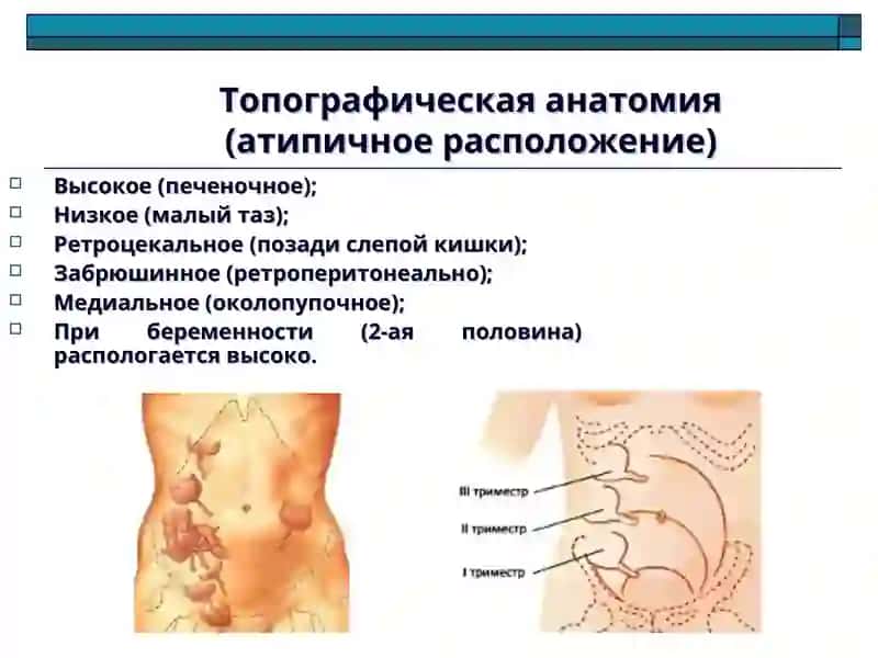 Острый аппендицит и его осложнения 4