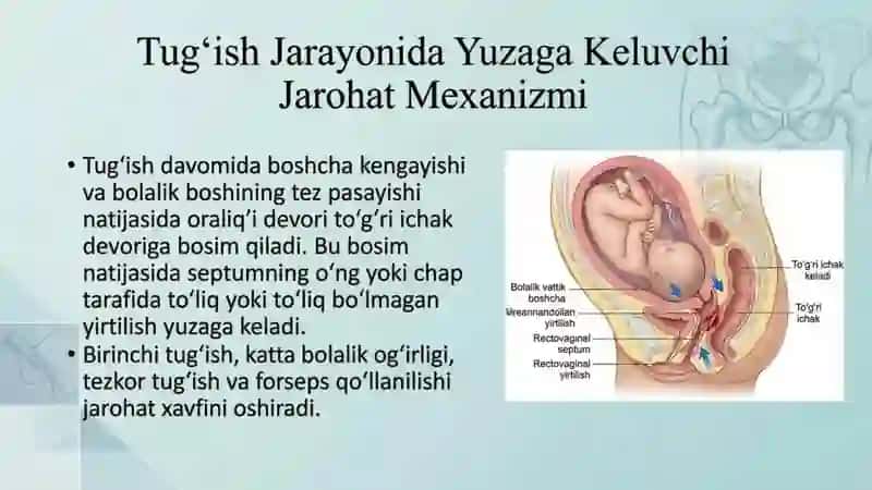 Ayollar oraligʻi va to'g'ri ichak jarohatlanishlarida  operatsiyalar qilish texnikasi 4