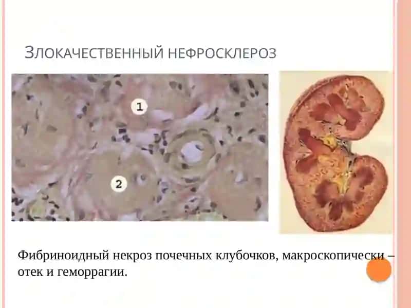 Сосудистая патология. Сосудистые аномалии. Гипертония.  атеросклероз. Аневризмы. Васкулиты. Патология венозных и лимфатических сосудов. Сосудистые опухоли. 4