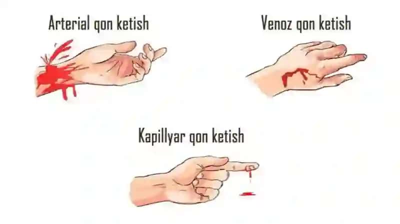 Qo‘l va oyoq qon tomirlarda bajariladigan operatsiyalar turlari va texnikasi 4
