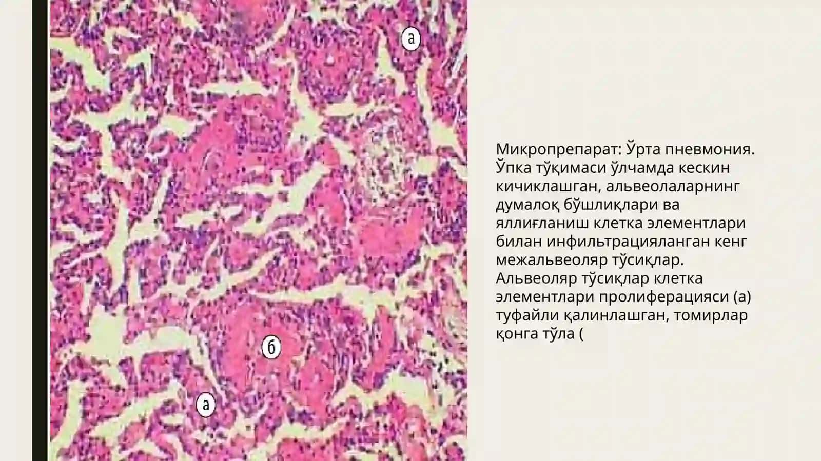 Макропрепарат: Сурункали атрофик гастрит 4