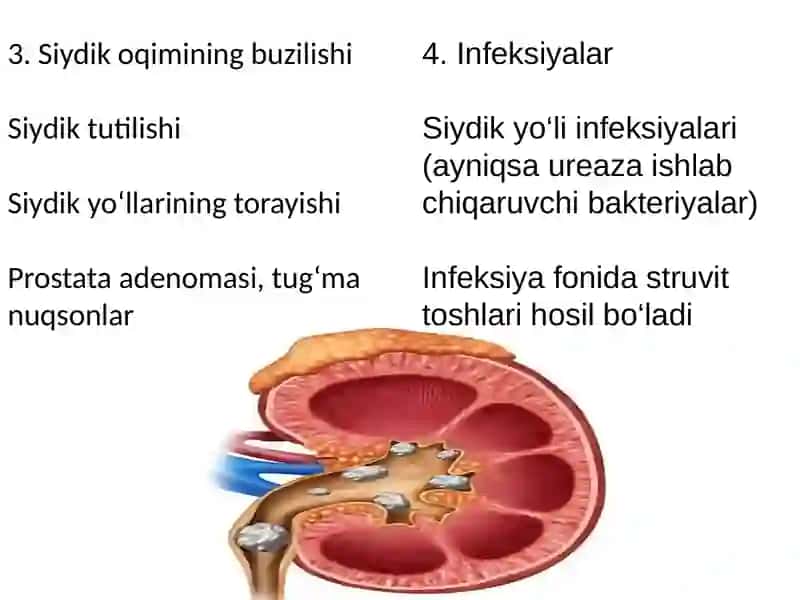 Buyrakda tosh hosil boʻlishi sabablari va mexanizmlari 4