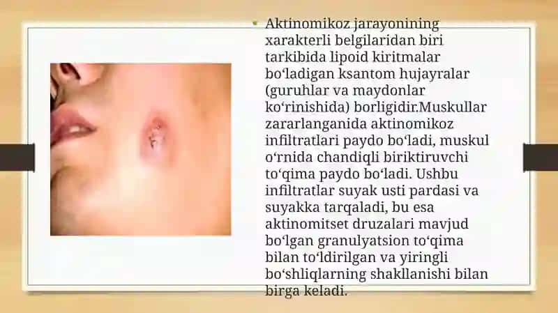 Aktinomikoz 4