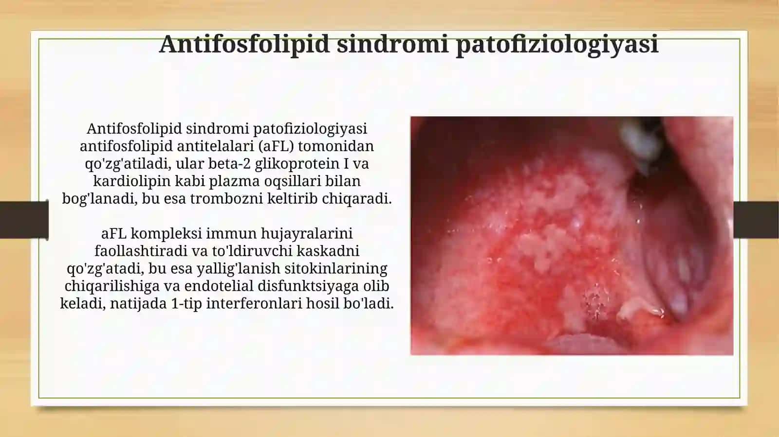 Antifosfolipid sindrom. Yalligʻlanishga qarshi Nosteroid va steroid dori vositalari 4