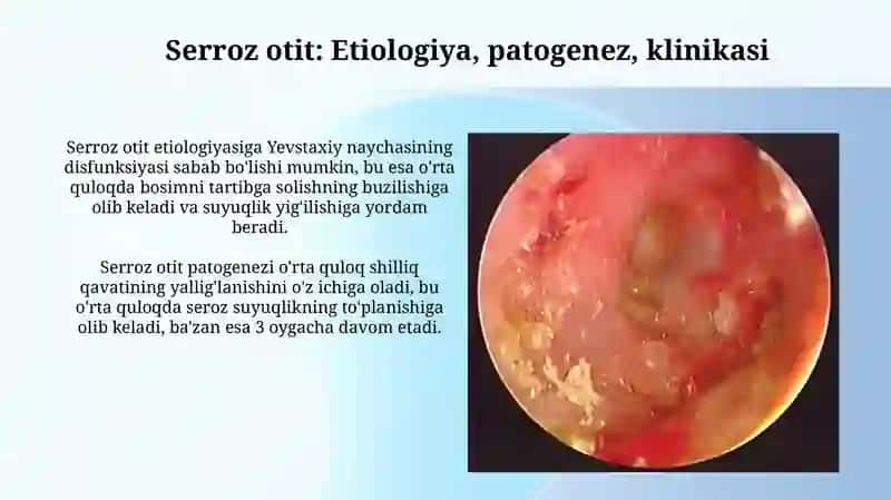Noyiringli quloq kasalliklari 4