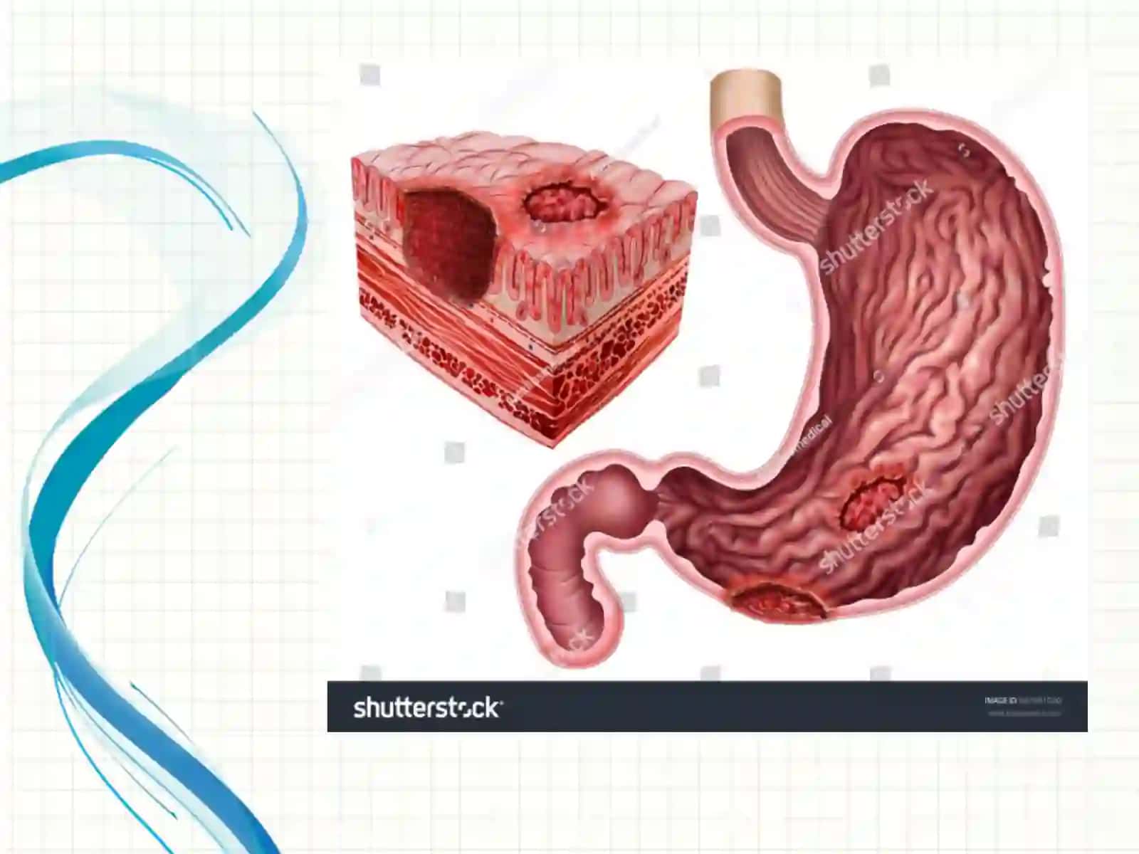 Oshqozon va o‘n ikki barmoqli ichak yara kasalligi asoratlari, diagnostikasi 4