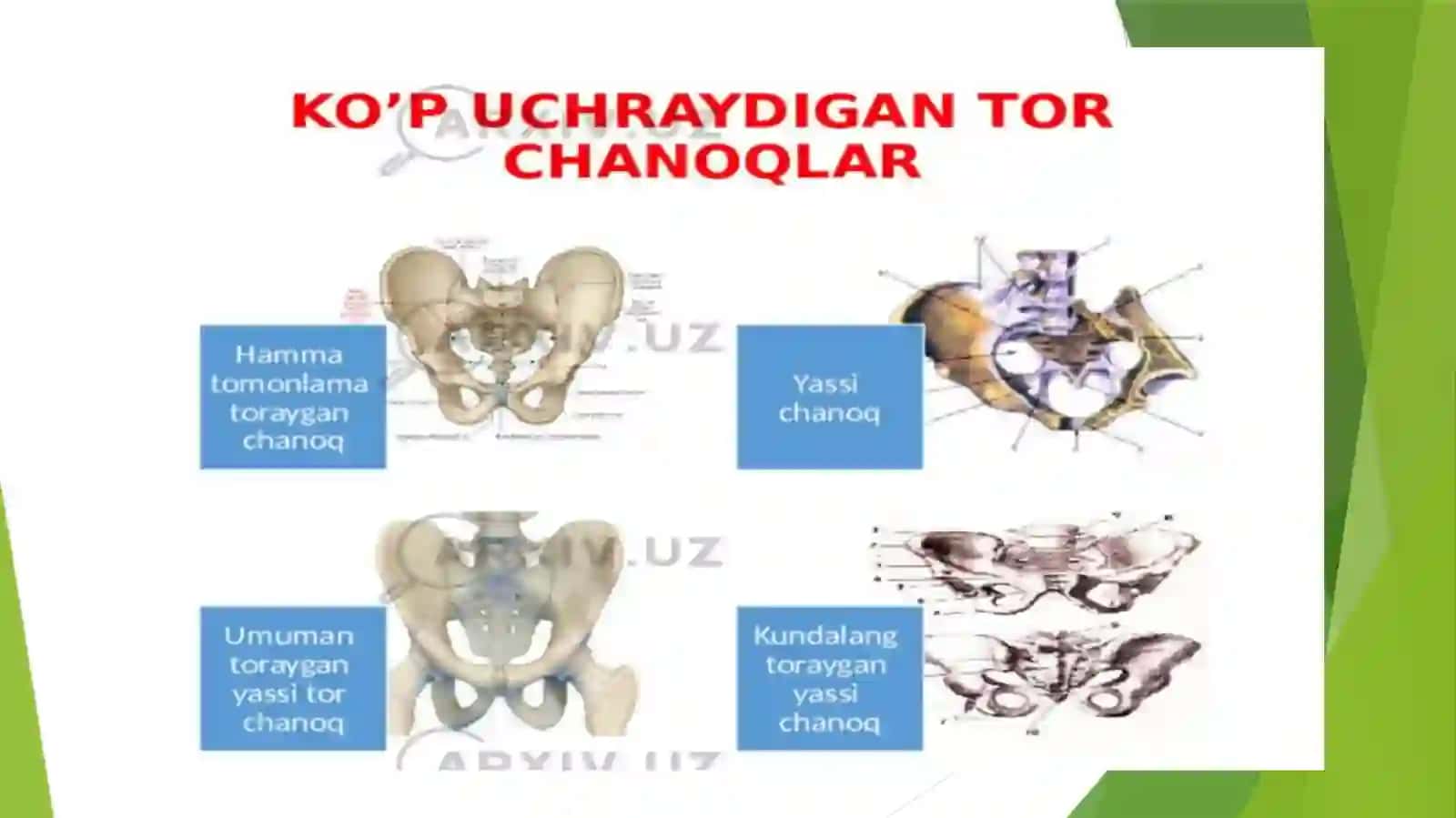 Tor chanoq. Etiologiyasi, tasnifi, tashxislash. Tug‘dirish usullari. Homiladorlik va tug‘ruqni kechi 4