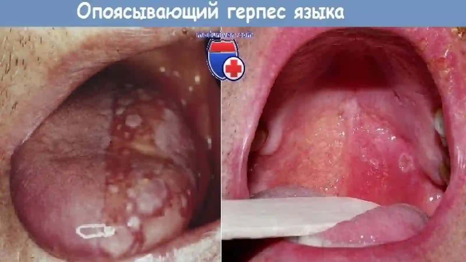 Mavzu: Virus kasalliklarini OBShQda (oddiy  gerpes, qamrab oluvchi temratki, gerpangina ) namoyon bo’lishi. 4