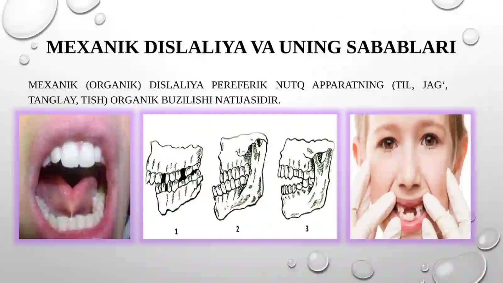 Dislaliyasabablari va shakllari,dislaliya turlari va uning namoyon bo‘lishi 4