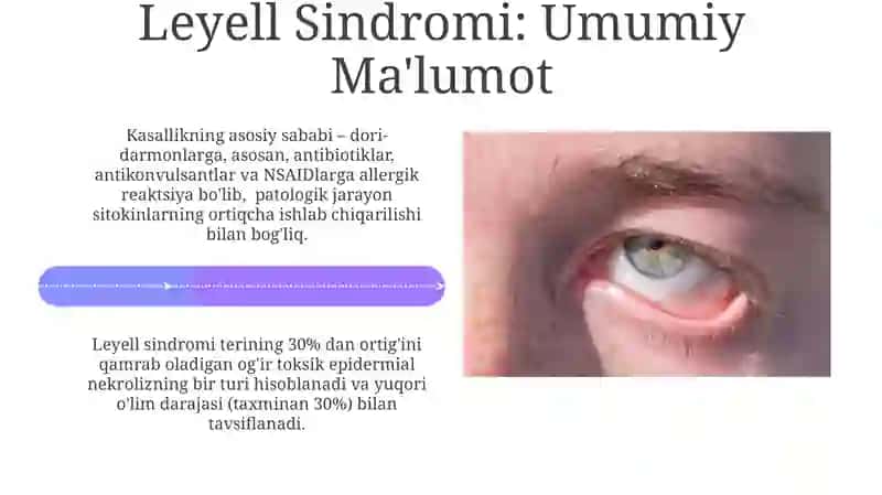 Layell sindromlari 4