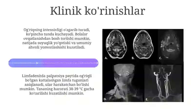 Bolalarda odontogenyallig'lanish jarayonlari: limfoadenit, absess, flegmonalar 4