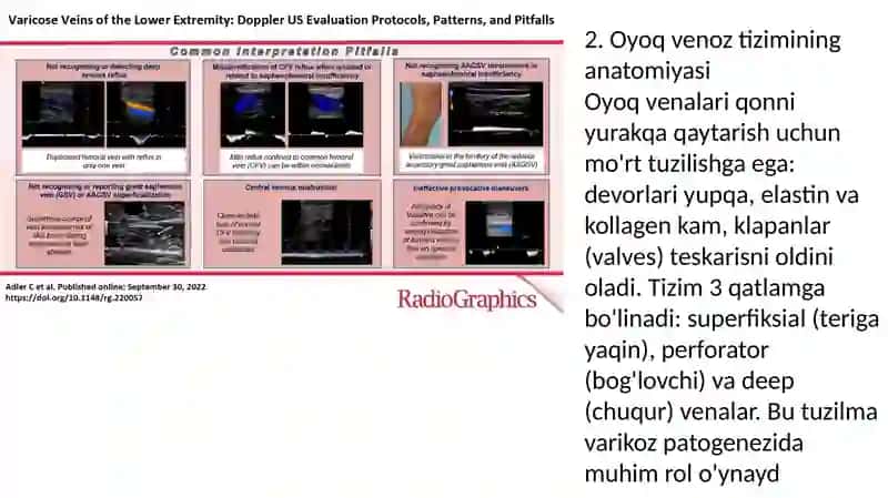 Oyoq venalari varikoz kasalligida bajariladigan operatsiyalar 4