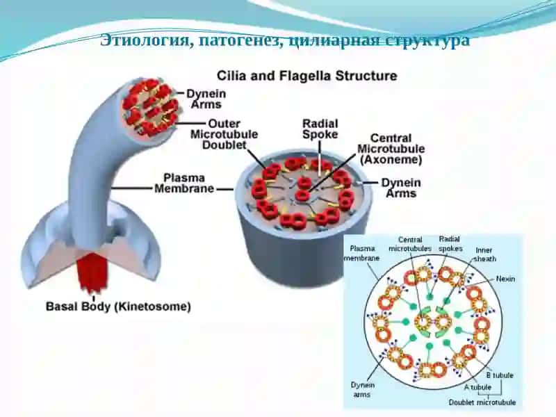 Синдром Картагенера 4