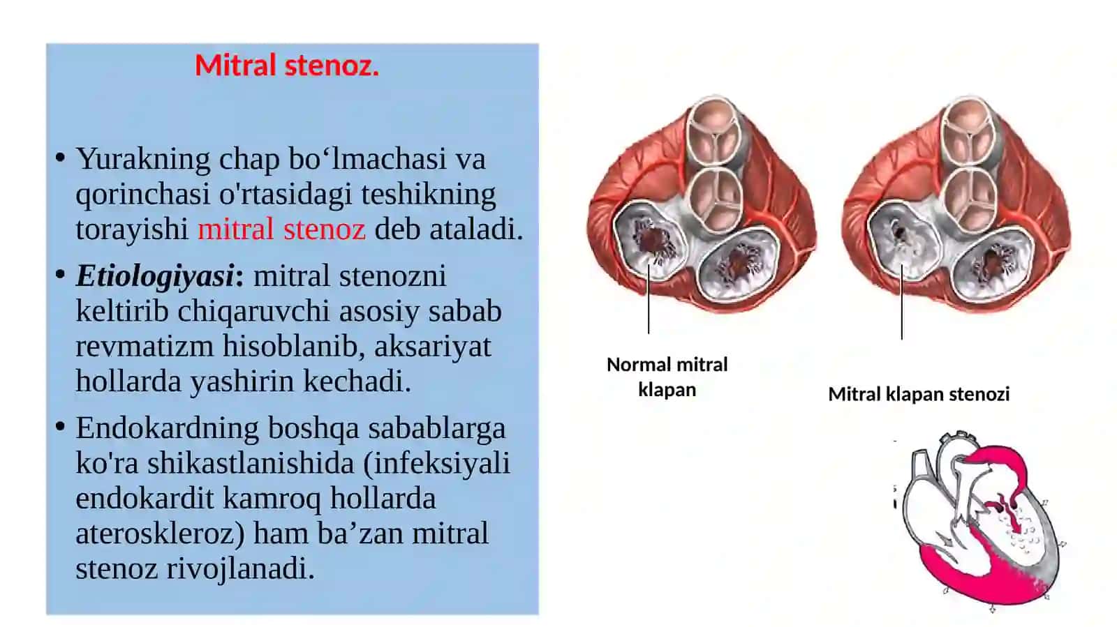 Ortirilgan yurak nuqsonlari. Mitral va aortal nuqsonlar 4