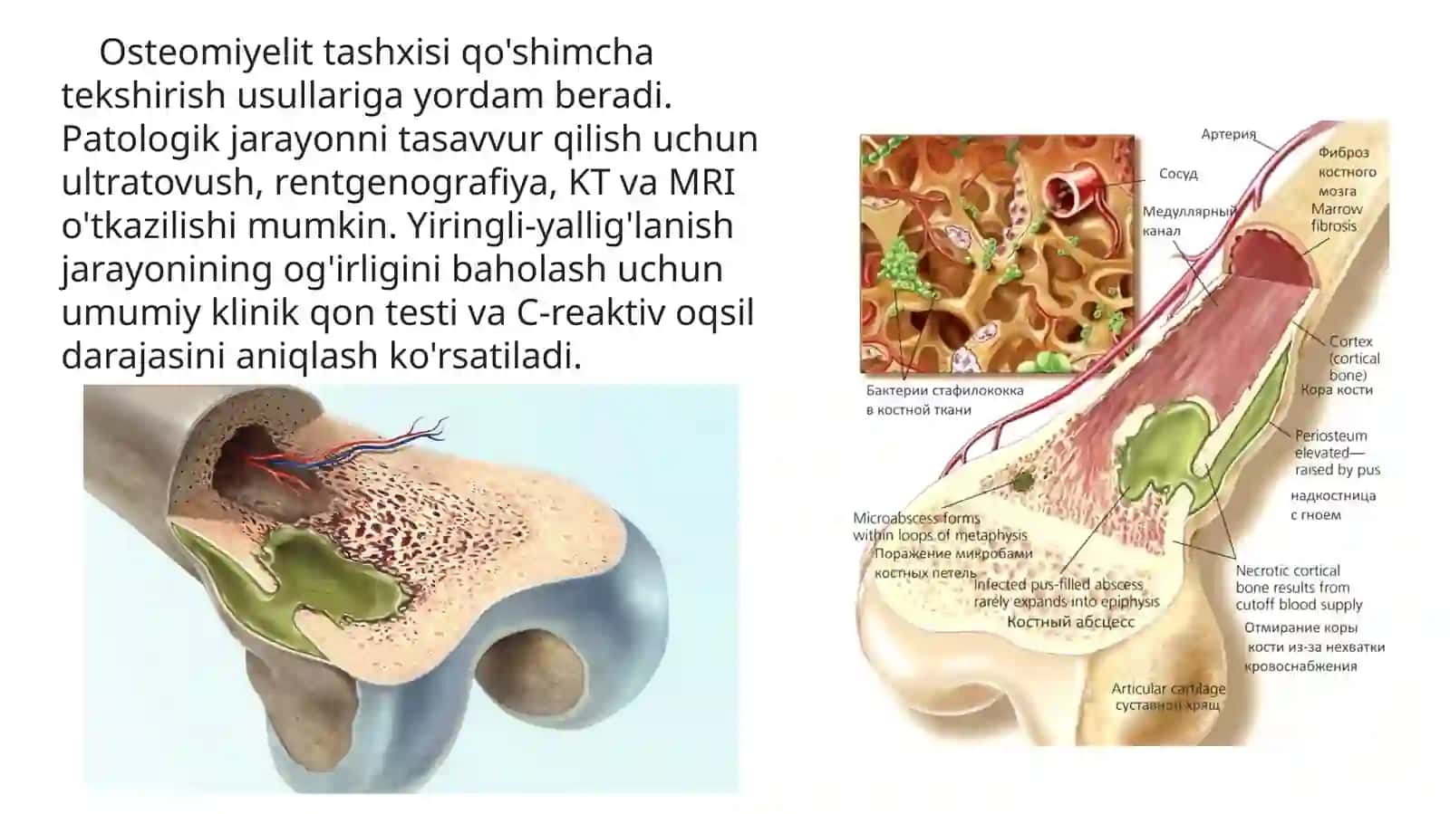 Gemotogenli osteomielit 4