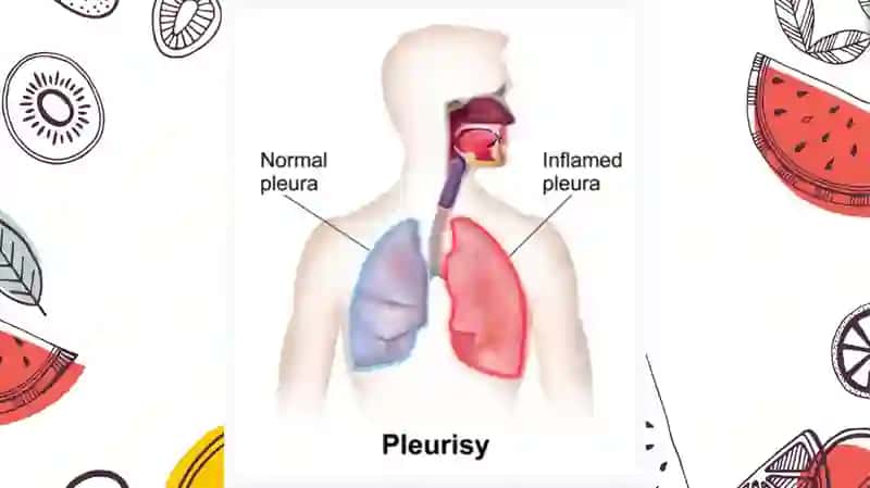 Plevrit 4