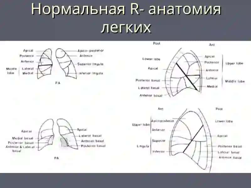 Лучевая диагностика заболеваний легких 4