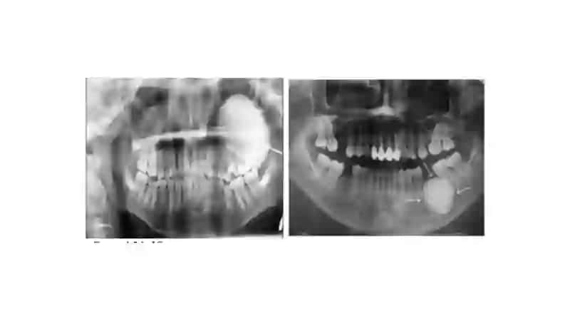 Xavfsiz osteogen o‘smalar. Klinikasi, tashxisi, davolash (osteoma, osteoid-osteoma, osteoblastoma, xondroma, osteoxondroma, gigant hujayrali o‘sma). 4