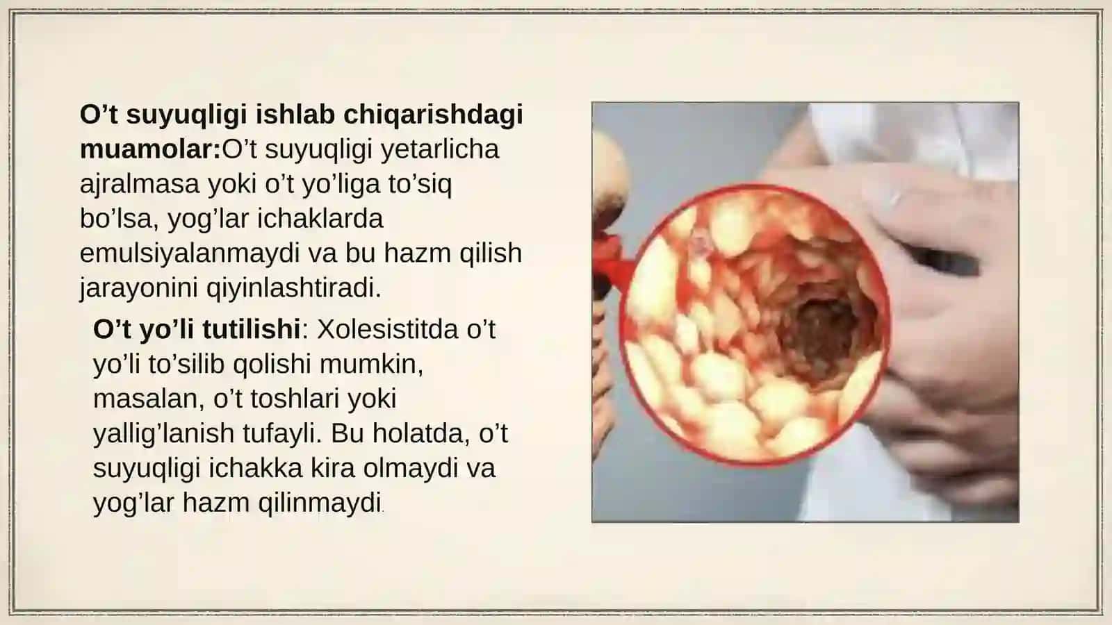 Xolesistitlarda yog 'lar hazmlanishini buzilishi(steatoreya) 4