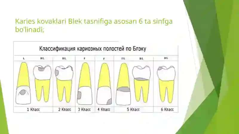 Кариес ковакларини чархлаш боскичлари ва услублари 4