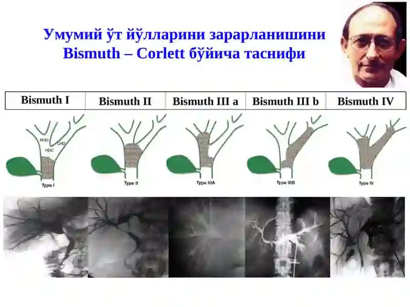 Механик сариқлик, постхолецистэктомик синдром 4